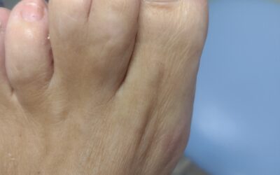 Sindactilia o dedos pegados: Tipos, causas y tratamiento